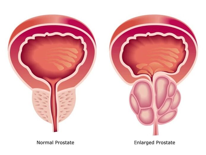 Prostovit normalizes the work and size of the prostate