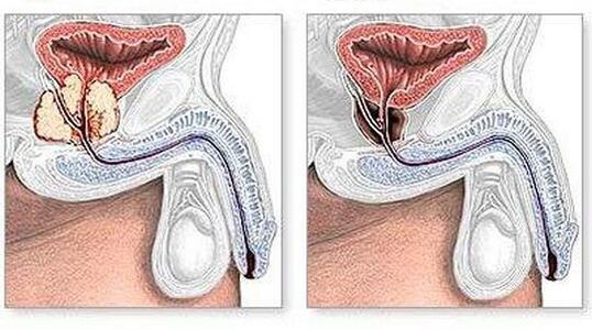 Before and after the treatment of chronic prostatitis surgically