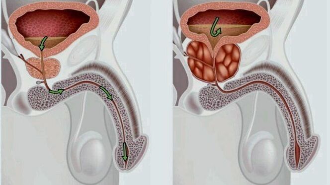 healthy and inflamed prostate with prostatitis