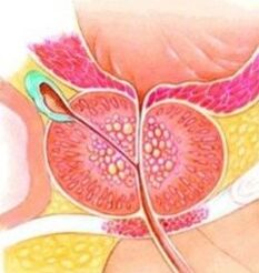 Prostate adenoma